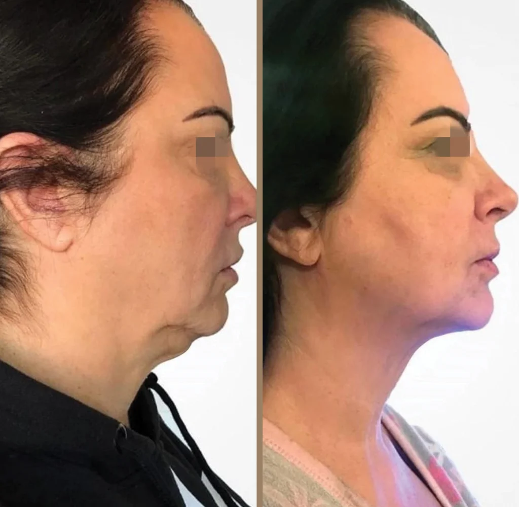 endolift 1
