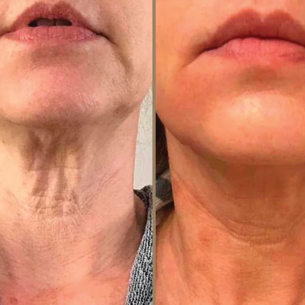 endolift 2