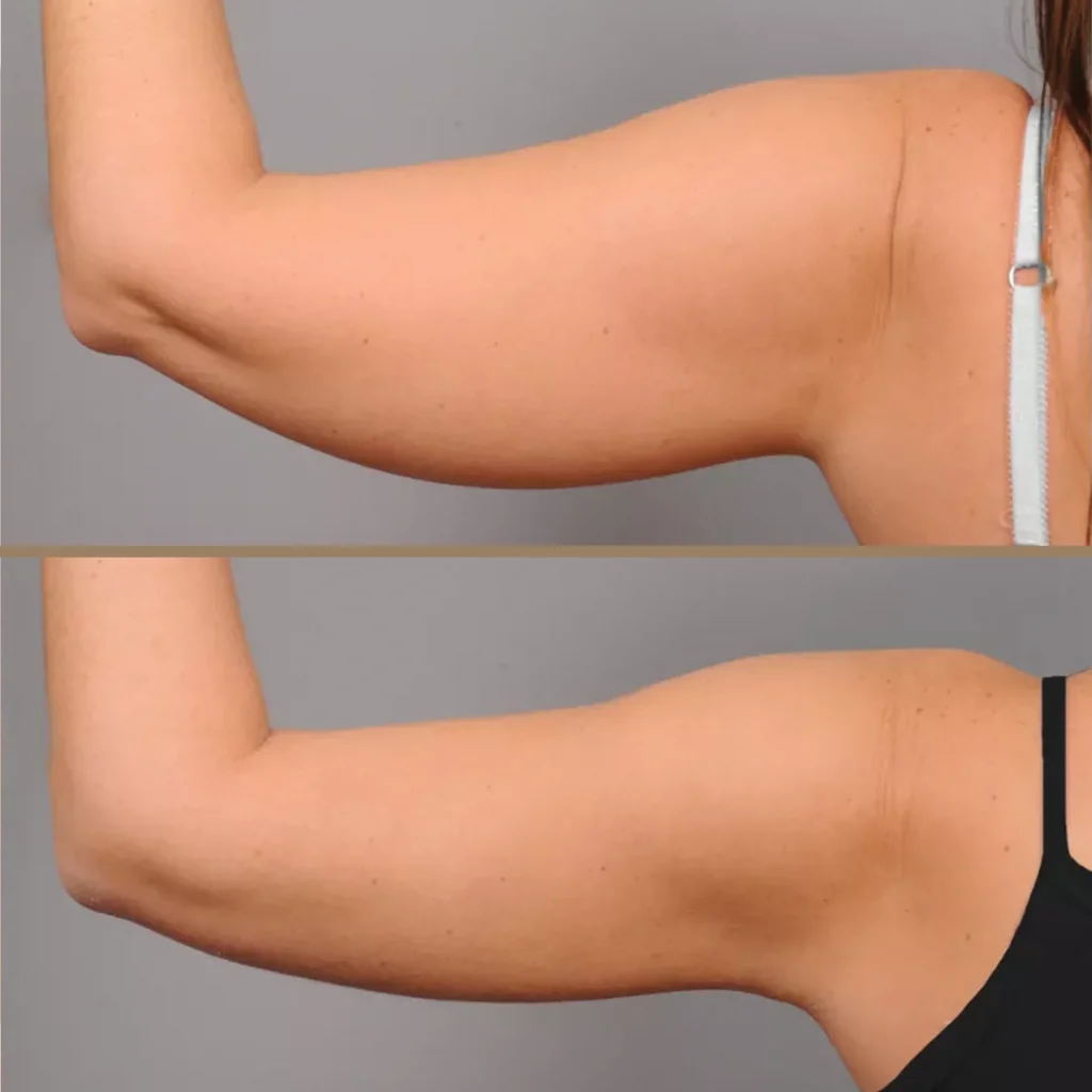 endolift 3